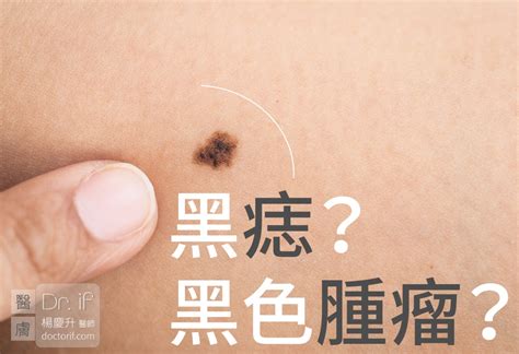 身體上的痣|痣是什麼？一次了解痣原因、就醫時機以及如何改善